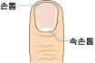 손톱